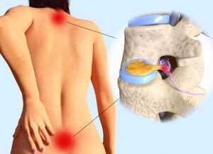 Slipped Disc Pain needs an Osteopath